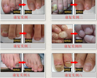 Средство для лечения Ногтей от грибков Mei Yan Qiong
